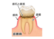 歯肉炎